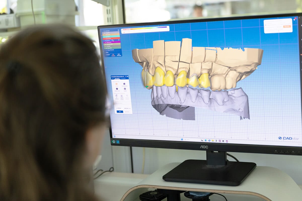 Person betrachtet am Computerbildschirm ein digitales 3D-Modell von Zahnkronen.