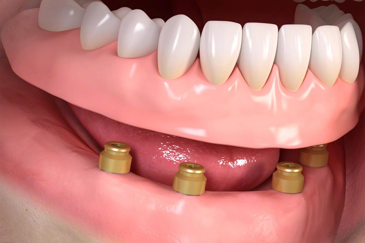 Zahnmodell mit vier goldfarbenen Implantatpfosten im Unterkiefer und darauf sitzendem Oberkiefer mit weißen Zähnen.