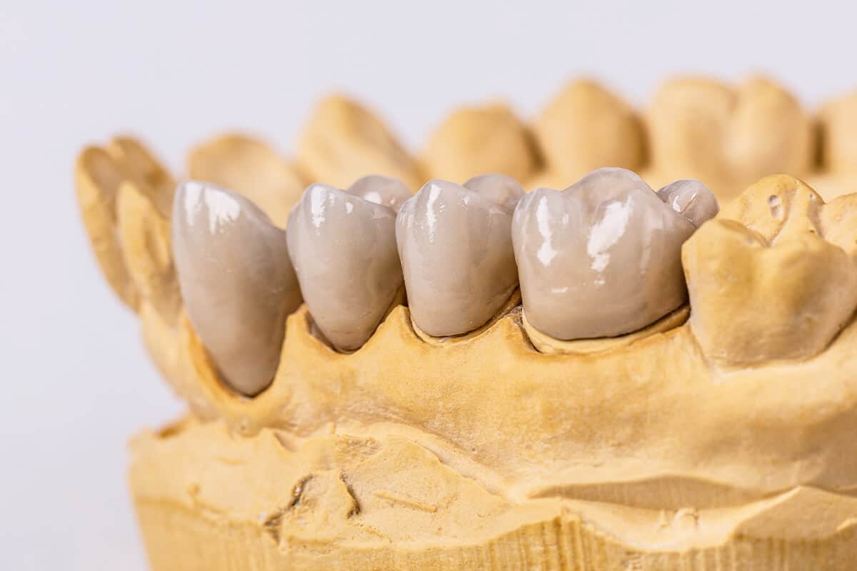 Nahaufnahme eines Zahnmodells mit mehreren Glaskeramik-Zahnersatzteilen auf gelbem Gipsabdruck.