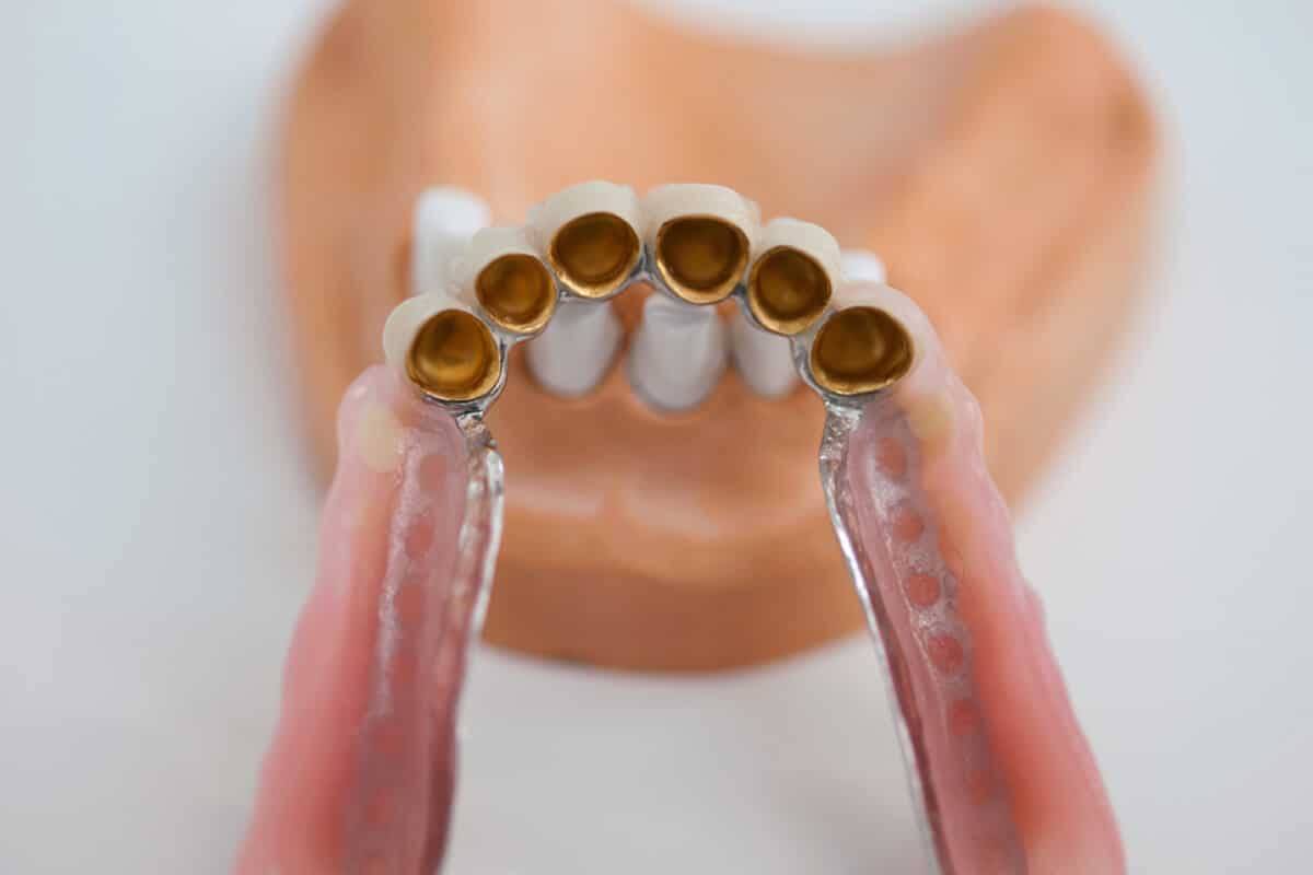Zahnprothese mit goldfarbenen Galvanoforming-Inlays auf einem Zahnmodell.
