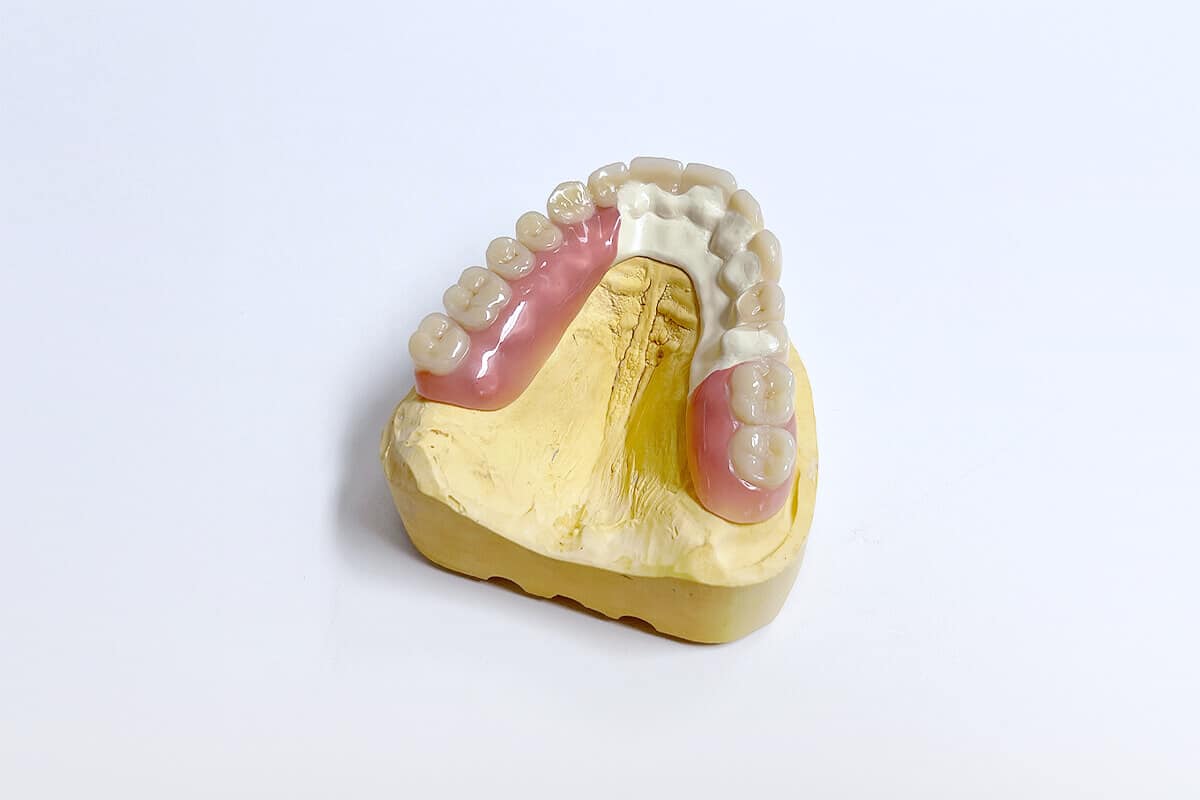 Modell eines Kiefers mit Zahnersatz aus Hochleistungskunststoff.
