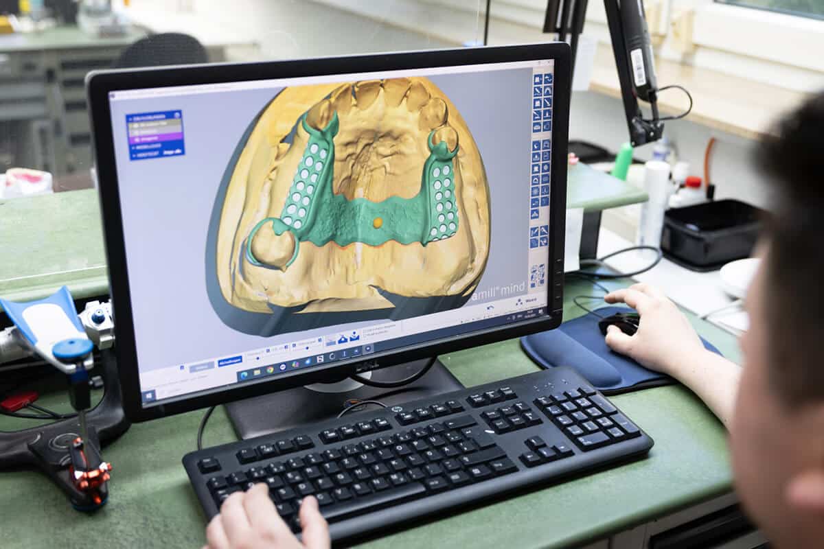 Computermonitor zeigt digitales 3D-Modell einer Modellgussprothese im Kieferbereich.